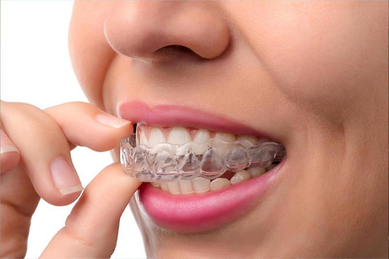 Αόρατοι νάρθηκες Invisalign στην Αθήνα - Ορθοδοντικός Παλαιό Φάληρο TK Orthodontics