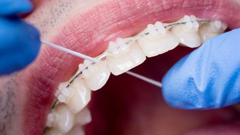 Κεραμικά σιδεράκια Αθήνα - TK Orthodontics, Dr. Τσιότρας Παλαιό Φάληρο
